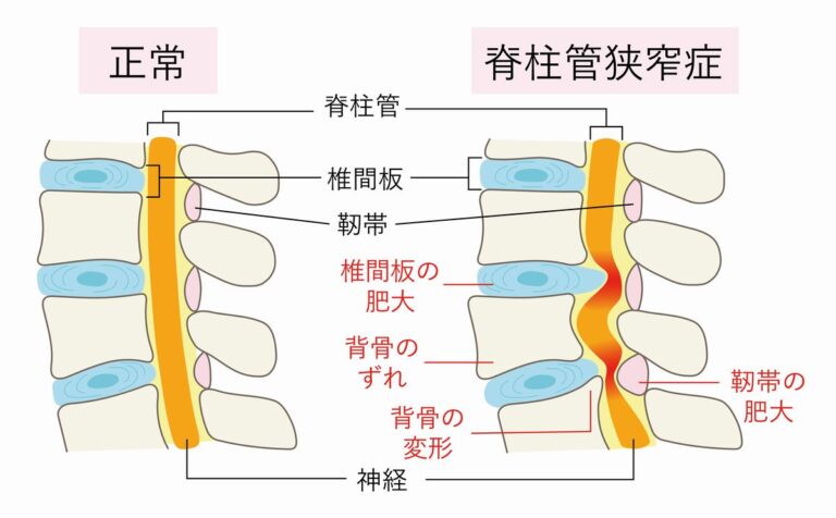 脊柱管狭窄症の原因