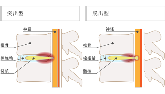 腰椎椎間板ヘルニア