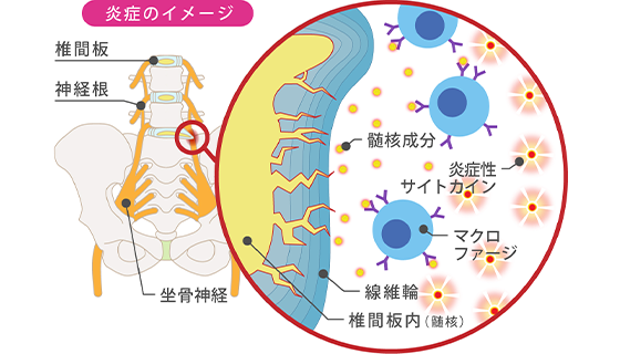 坐骨神経痛