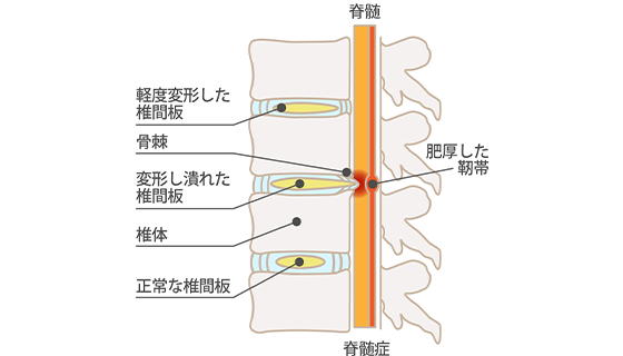 腰部脊柱管狭窄症