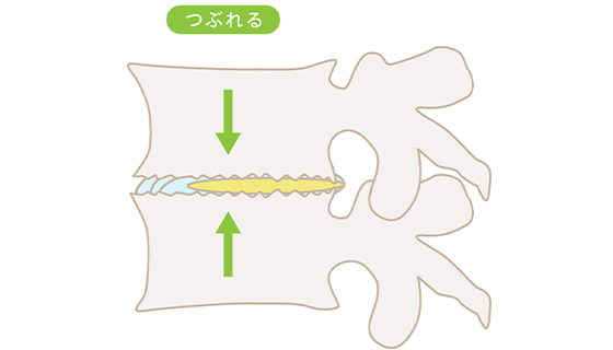 椎間板変形症