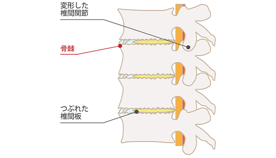 変形性腰椎症