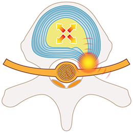 PDR法（経皮的椎間板修復治療）