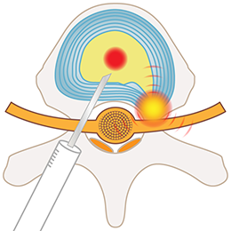 PDR法（経皮的椎間板修復治療）
