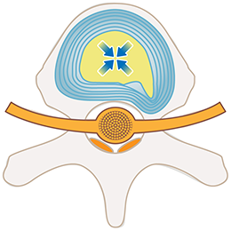 PDR法（経皮的椎間板修復治療）
