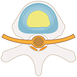 PDR法（経皮的椎間板修復治療）
