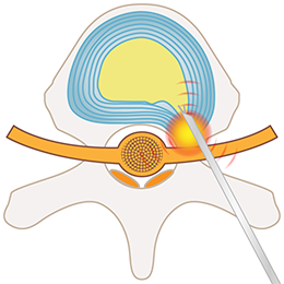 PED法（経皮的内視鏡下椎間板摘出術）