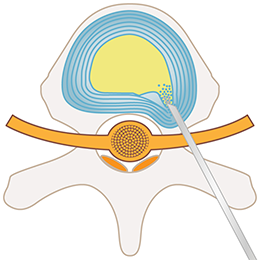 PED法（経皮的内視鏡下椎間板摘出術）