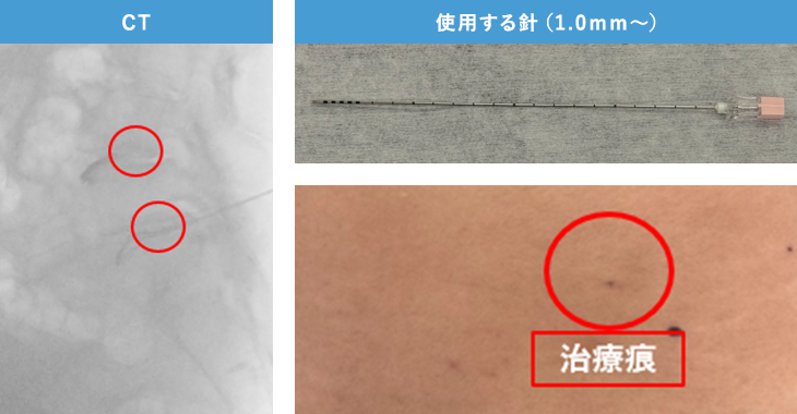 PED法（経皮的内視鏡下椎間板摘出術）