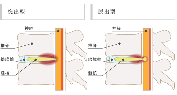 腰椎椎間板ヘルニア