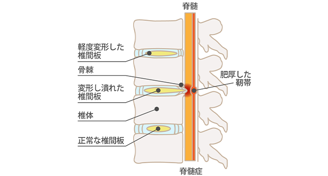 腰部脊柱管狭窄症