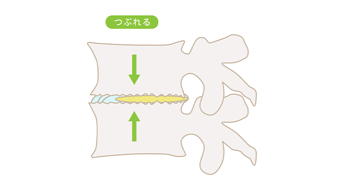 椎間板変形症