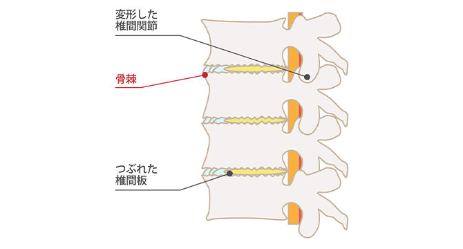 変形性腰椎症