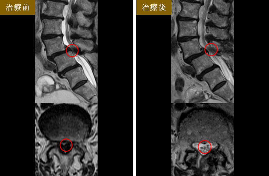 PEL法（脊柱管狭窄症内視鏡下手術） 