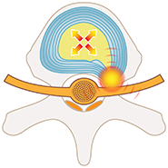 PLDD法（経皮的レーザー椎間板減圧術）