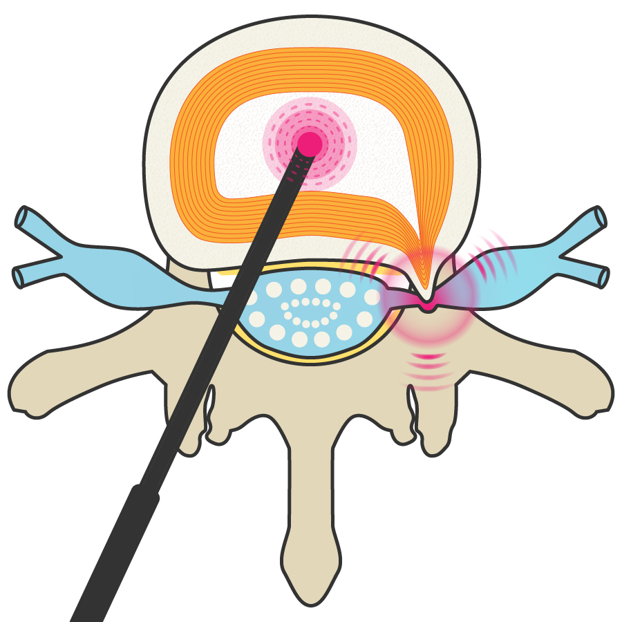 PLDD法（経皮的レーザー椎間板減圧術）