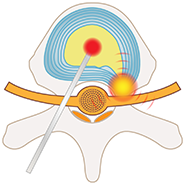 PLDD法（経皮的レーザー椎間板減圧術）