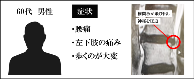 椎間板ヘルニア60代男性の症例