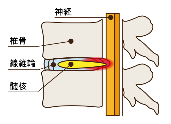 椎間板ヘルニア