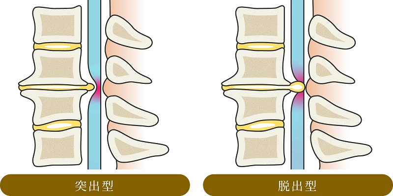 腰椎椎間板ヘルニア