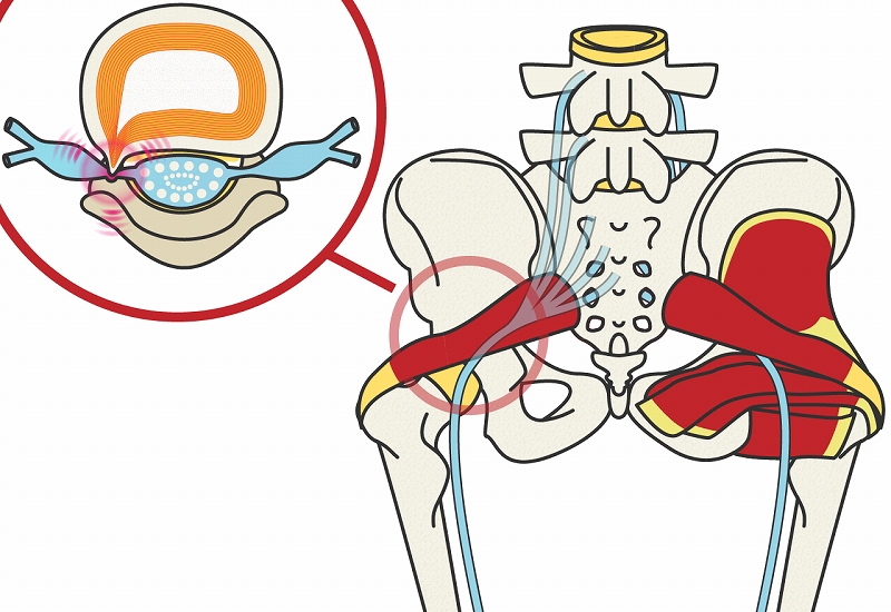 坐骨神経痛