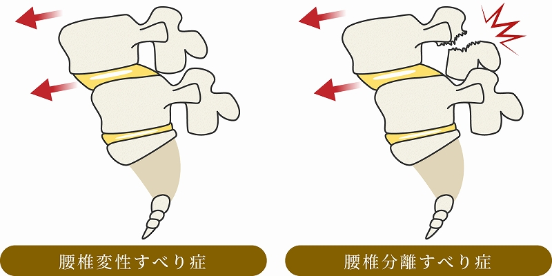 腰椎すべり症