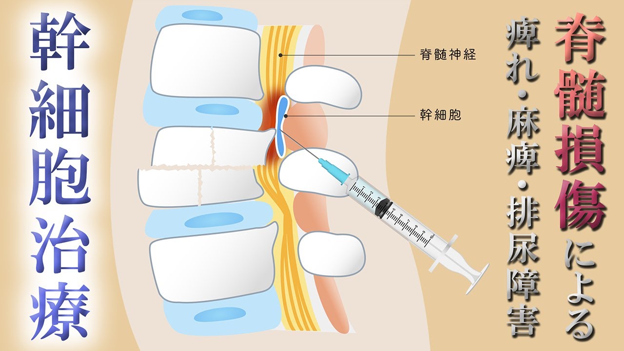 【脊髄損傷の治療法】幹細胞を脊髄に直接注射することで再生を促す治療とは？