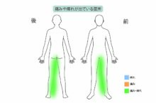 80代男性「固定術後の合併症である隣接椎間障害による痛みと痺れを『PEL（脊柱管狭窄症内視鏡下手術）』と再生医療『PRP療法』で治療した症例